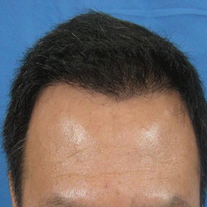 6 Months After Surgery Set 1