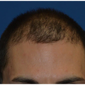 male hair restoration san diego using neograft
