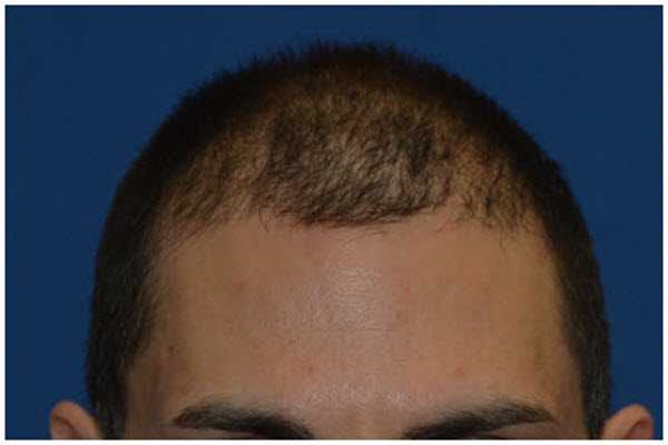 male hair restoration san diego using neograft