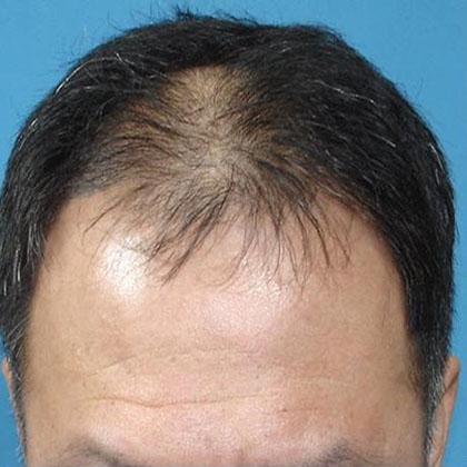 Before Hair Restoration Surgery Set 1